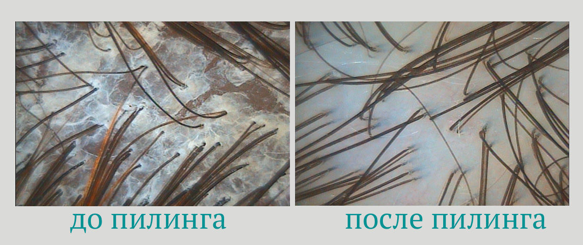 Рецепты пилинга кожи головы в домашних условиях